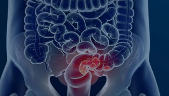 © Câmara Municipal de Afonso Claudio/Divulgação Rastreamento para câncer colorretal pode ser implementado no SUS